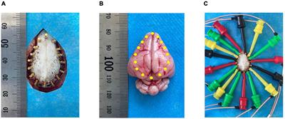 A pilot study of contrast-enhanced electrical impedance tomography for real-time imaging of cerebral perfusion